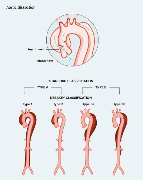 Aortic dissection